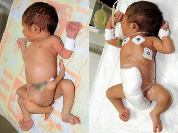   Bebê de seis pernas passa por cirurgia no Paquistão
