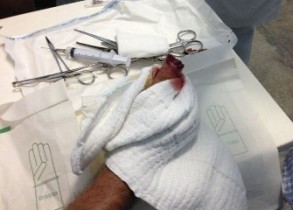 Cliente arranca dedo de PM com mordida em quebra-quebra na Coelba