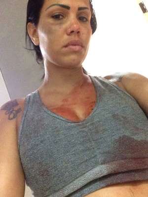 Cantora afirma ter sido agredida por ex-namorado: 'Me bateu demais'