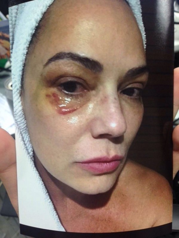 Luiza Brunet diz que fotos provam que foi agredida pelo ex-marido