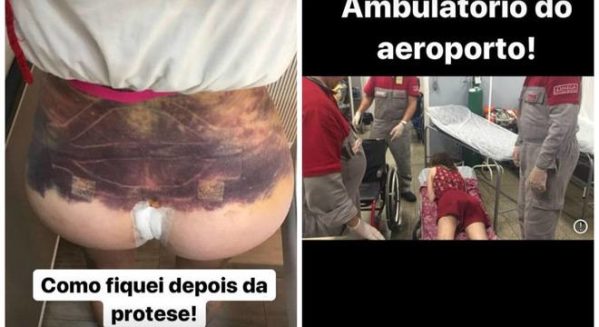 Camilla mostrou hematomas e sua chegada ao hospital (reprodução/Instagram)