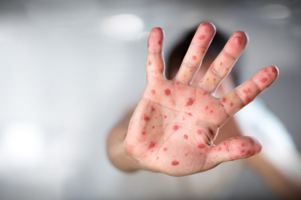Secretaria de Saúde confirma quarto caso de sarampo em Sergipe